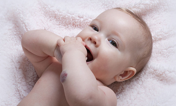 Baby with a visible vascular anomaly visible as a blemish on the baby's arm.