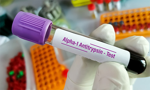 sample from an Alpha-1-antitrypsin test