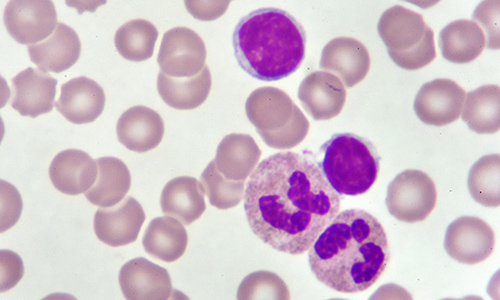 llustration of CLL cells