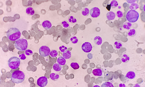 photo illustration of chronic myeloid leukemia molecules