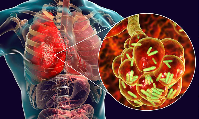 Illustration of lung and pneumonia cells