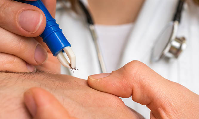 A clinician removes a tick from a hand.