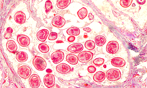 A microscopic slide of echinococcosis infection