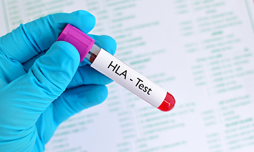 A gloved hand holds an HLA test sample