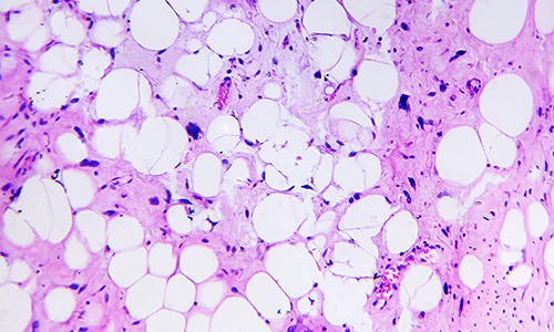 Microscopic image of soft tissue sarcoma