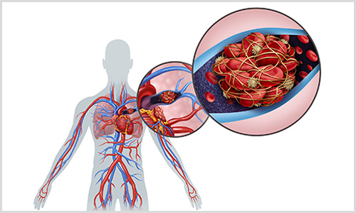 photo illustration of artery blockage