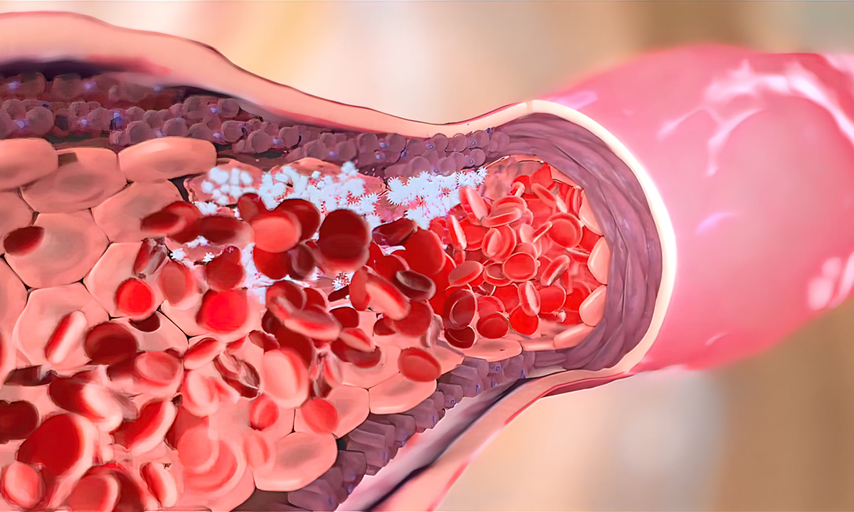 Illustration of the condition of venous thromboembolism