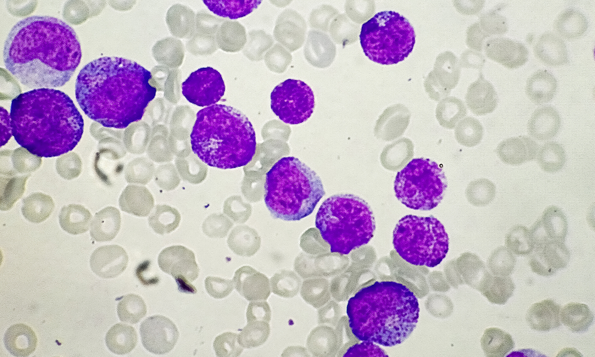 Photo illustration of chronic myeloid leukemia molecules
