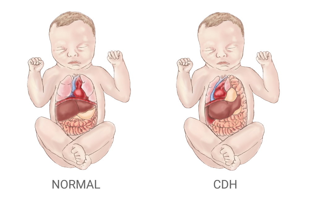An illustration comparing the organs of a normal infant to those with CDH