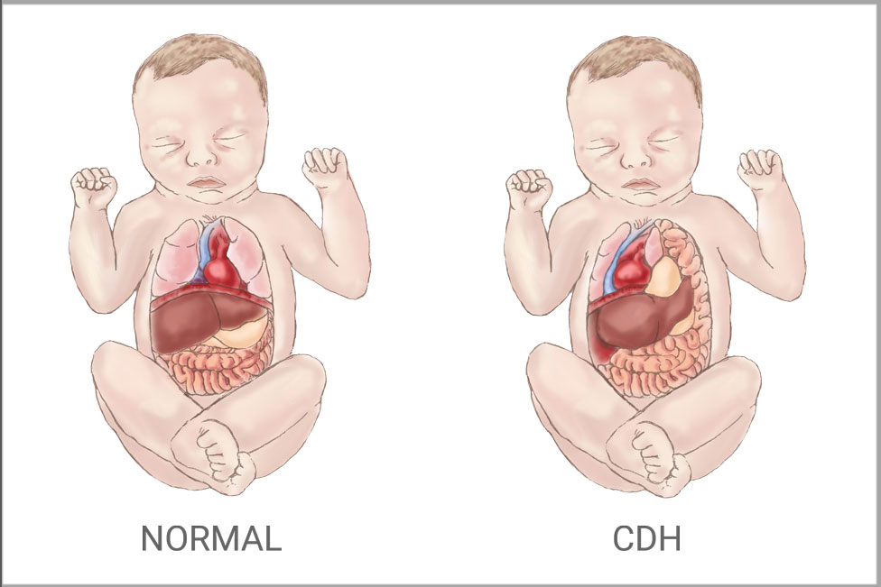 An illustraion comparing the organs of a normal infant to those with CDH
