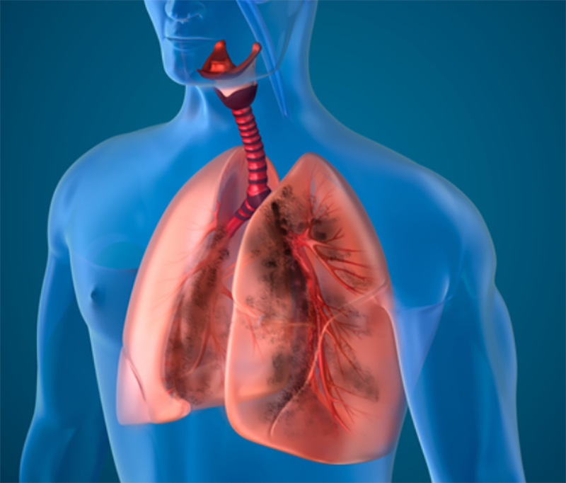 Interstitial Lung Disease